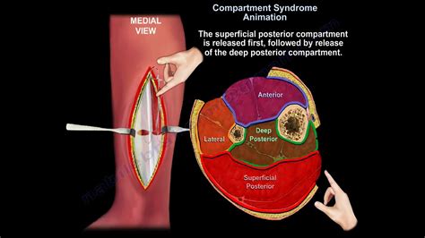 compartment syndrome compression test|compartment syndrome symptoms lower leg.